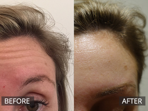 Forehead lines reduced with anti-wrinkle injections. - 7