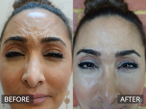 The frown area can give us an over angry look. This is 2 weeks post anti-wrinkle injections to the Frown area. - 8