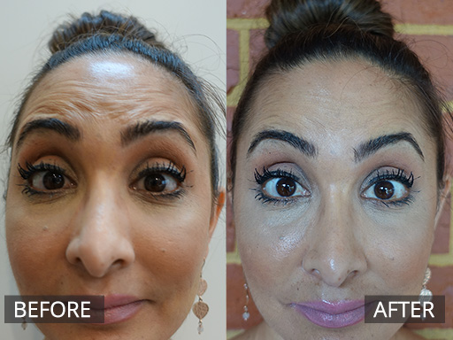 The Forehead lines can be reduced with anti-wrinkle lines to reduce the “worried look”. This patient required 10 units of type b anti-wrinkle injections. - 9