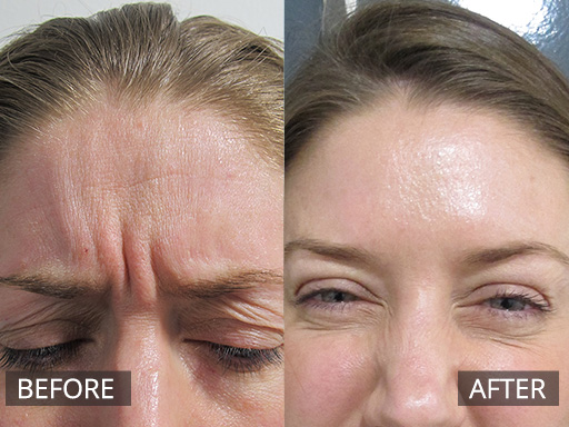 The frown area can be softened and also may reduce headaches. This patient had 24 units of type b anti-wrinkle injections. - 11