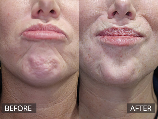 Chin softening with anti-wrinkle injections is possible to soften the dimpling in the chin shown with this patient. - 3