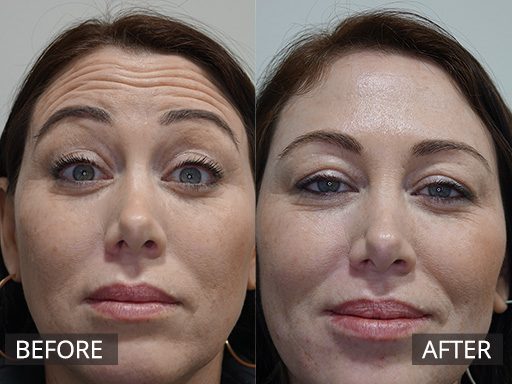 Forehead lines reduced with anti-wrinkle injections. With results peaking at the 2 week mark post the treatment. - 4