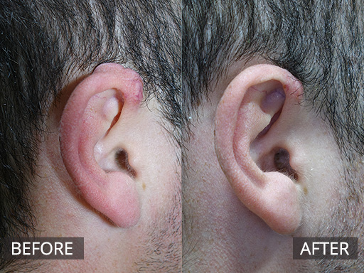 Keloid Scar Management-1 - 22