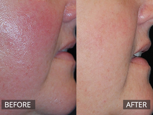 Rosacea-3 - 3