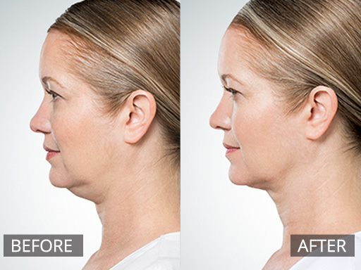 Double chin injection treatment showing reduction in the sub-mental area after 3 treatments spaced 6 weeks apart. - 28