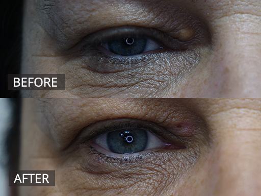 Xanthelasma Treatment-1 - 2