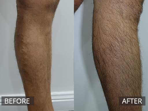 Medial leg varicose veins treated with one visit of Ultrasound guided sclerotherapy. - 36
