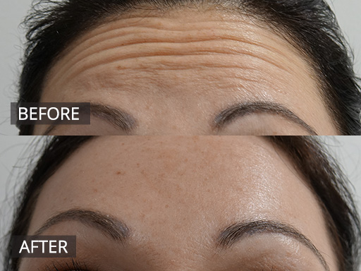 Worry lines eradicated with anti-wrinkle injections. 2 weeks has elapsed since treatment and after images. - 13