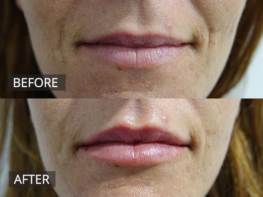 Lips to love! Natural, larger and immediately post treatment of 1ml dermal filler. - 7