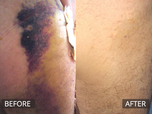 Healite - Post-Operative Haematoma - 1