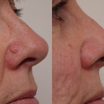 Can I Have a Mole Removed Without Scarring? 2 Can I Have a Mole Removed Without Scarring? - 2