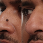 Can I Have a Mole Removed Without Scarring? 3 Can I Have a Mole Removed Without Scarring? - 3