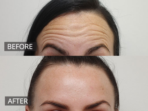 anti-wrinkle injections ba-01 - 15