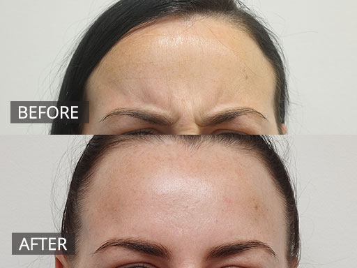 anti-wrinkle injections ba-02 - 14