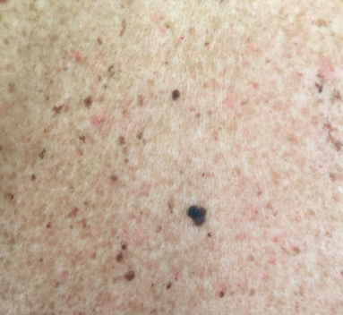 Mole Removed(Melanoma) Mole Removed(Melanoma)
