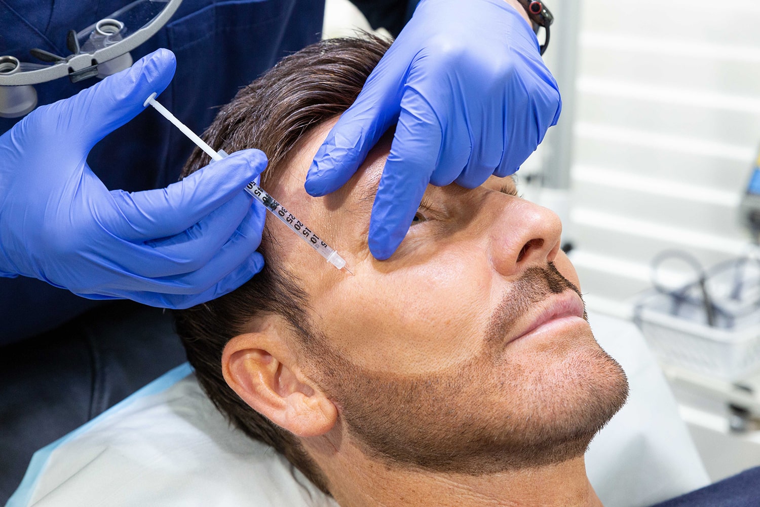 Upper Lip Lines and Under Eye Wrinkles Rejuvenation - 2