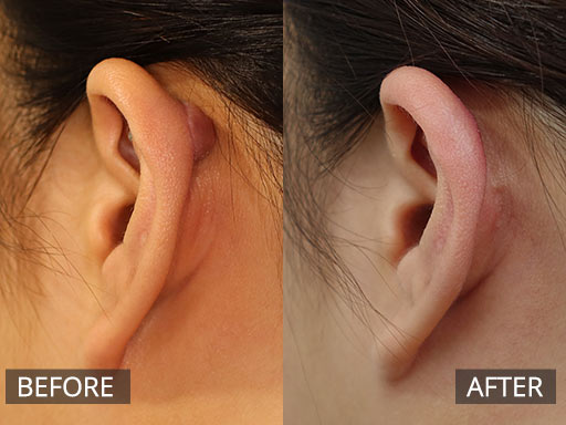 Before and after Upper posterior ear keloid removal - 34
