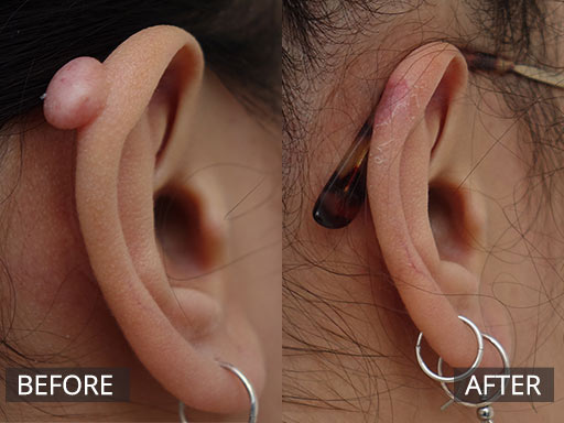 Ear keloid removal – 3 months post 003 - 80