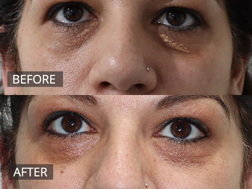 XANTHELASMA removal. After -4months POST_003 - 6