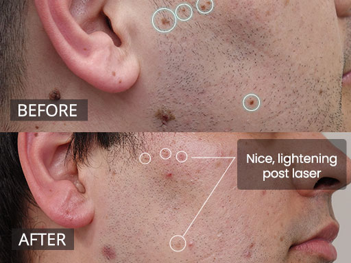 Laser Mole Removal Gallery - 8