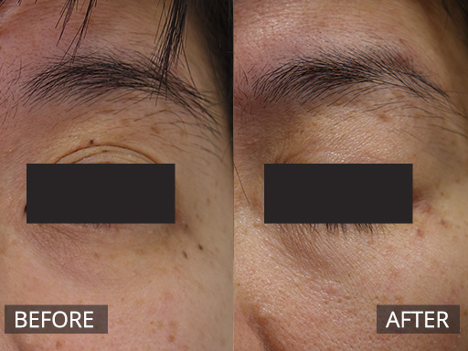 Laser Mole Removal Gallery - 5