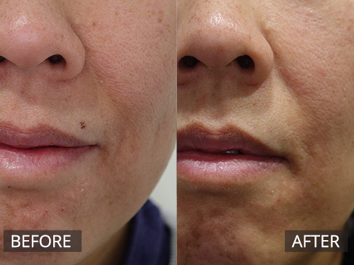 Laser Mole Removal Gallery - 4