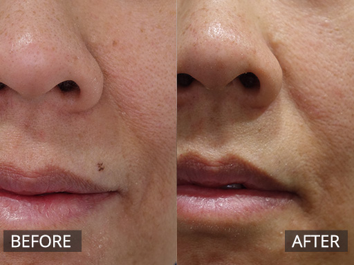 Laser Mole Removal Gallery - 2