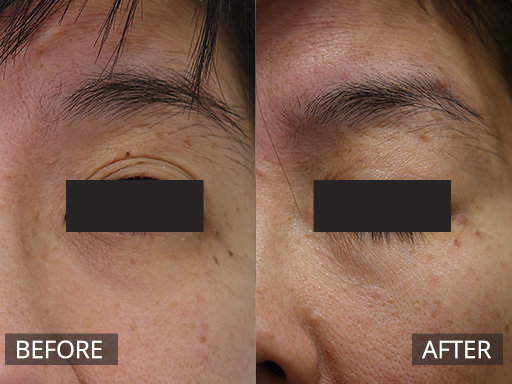 Laser Mole Removal Gallery - 1