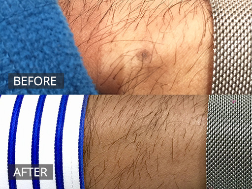 Laser Mole Removal Gallery - 7