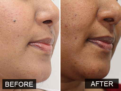 Laser Mole Removal Gallery - 9