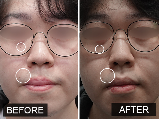 Laser Mole Removal Gallery - 12
