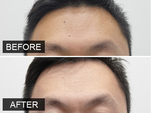Laser Mole Removal Gallery - 13