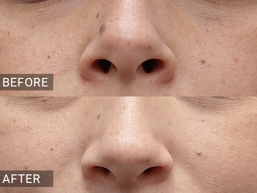 Laser Mole Removal Gallery - 15