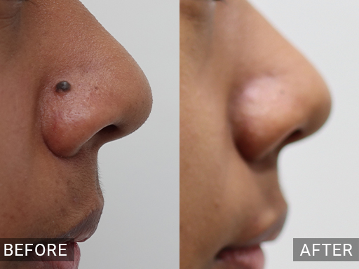 Laser Mole Removal Gallery - 17