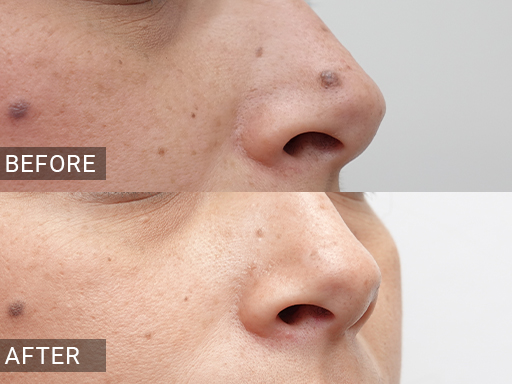 Laser Mole Removal Gallery - 16