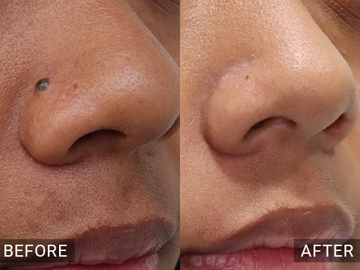 Laser Mole Removal Gallery - 18